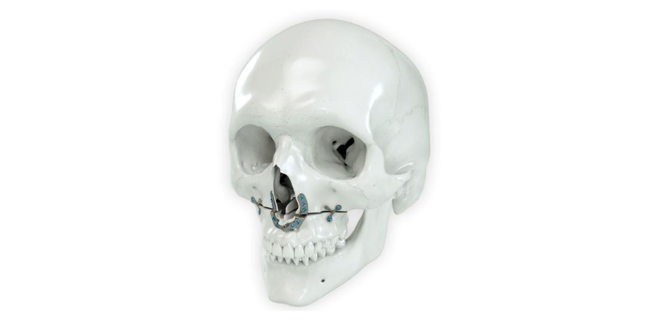 Minimally invasive Jaw surgery